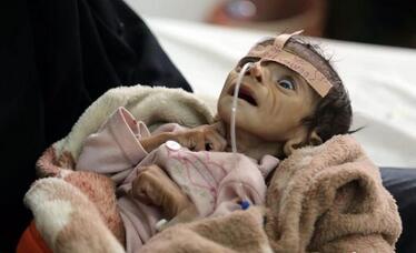 也门5个月大婴儿重2.4公斤 因严重营养不良离
